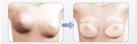 breast implant change tunisia